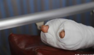 手指修复再造手术 手指修复再造手术